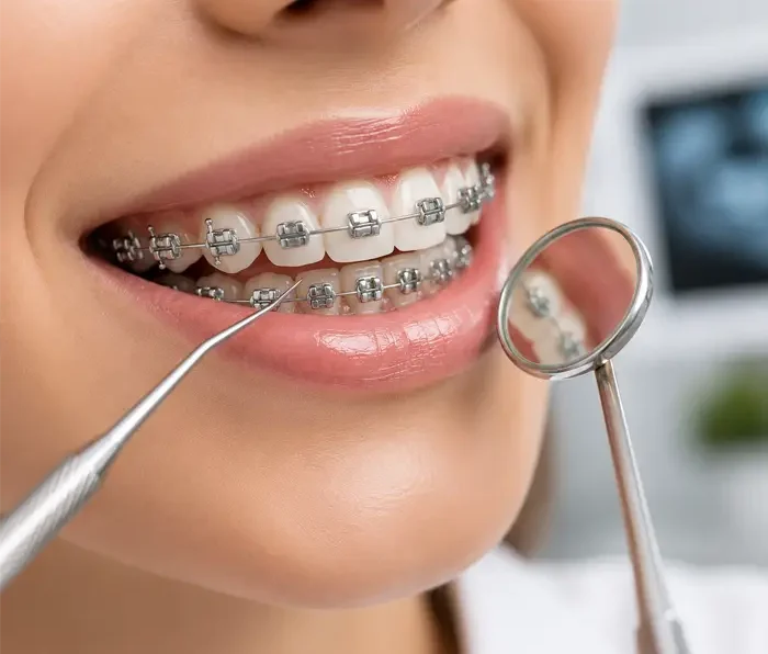 Ortodonti Tedavileri marlen clinic